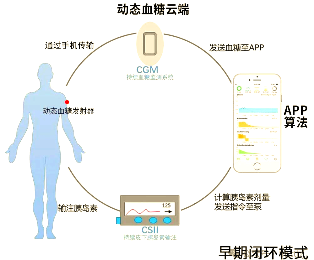 美敦力780g 革命性的閉環(huán)式胰島素泵，引領(lǐng)高效、穩(wěn)定與精確的糖尿病管理